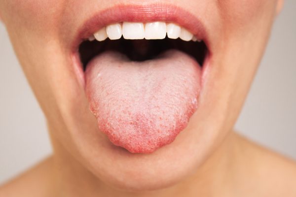 О чем говорит ваш язык: нутрициолог назвала главные признаки проблем со здоровьем